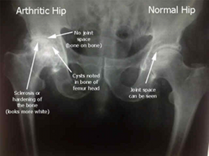 The Real Truth About Hip Pain