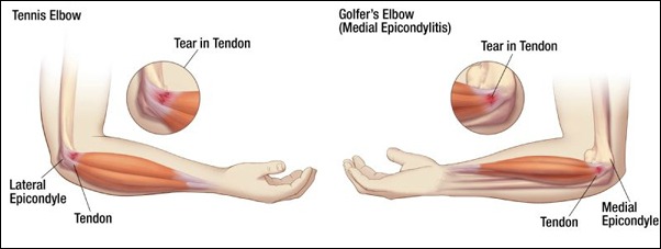 Stretches for Elbow Pain