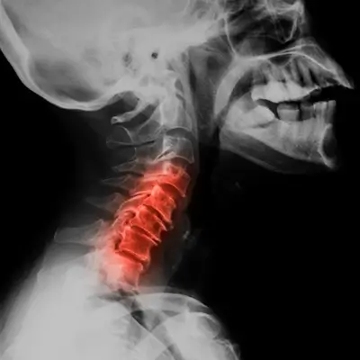 Cervical Spine Osteoarthritis: Symptoms & Prevention