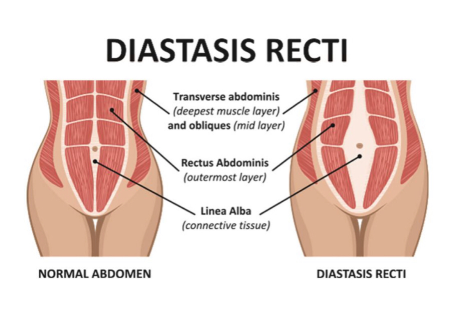 What Is Diastasis Rectus Abdominis and How Do I Know If I Have It?