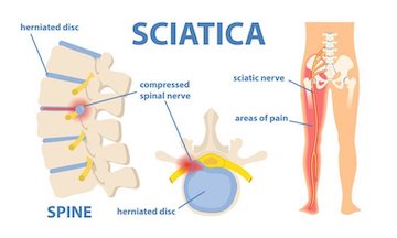Sciatica as symptom from herniated disc and spinal nerve outline diagram –  VectorMine