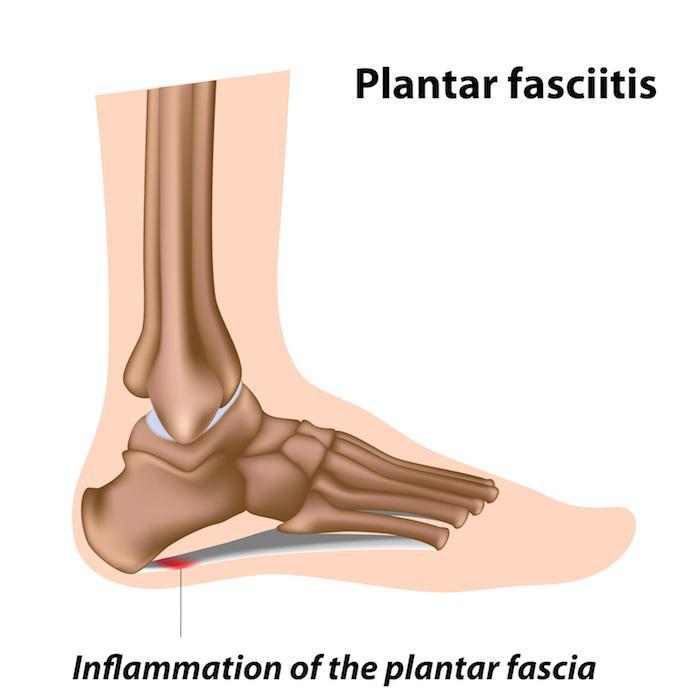 Plantar Fasciitis - Diagnosis and Treatment